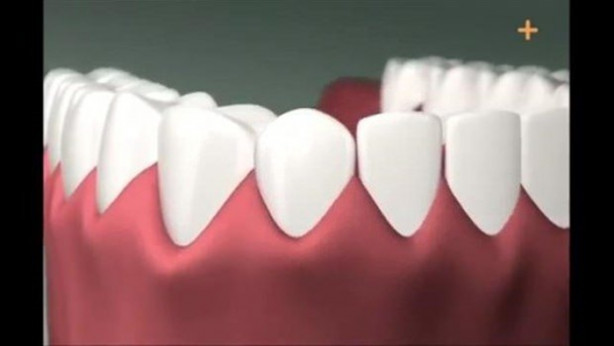 Foto - Diş implantı nasıl yapılıyor?