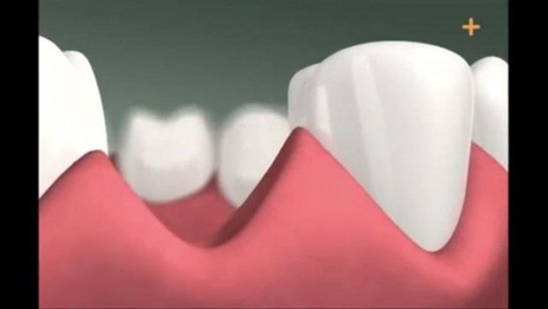 Foto - Diş implantı nasıl yapılıyor?