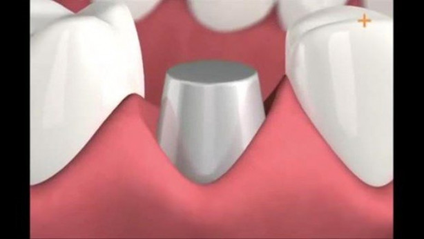 Foto - Diş implantı nasıl yapılıyor?