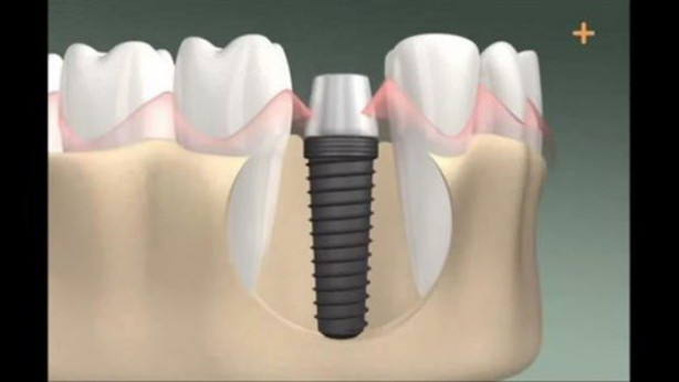 Foto - Diş implantı nasıl yapılıyor?