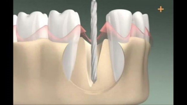 Foto - Diş implantı nasıl yapılıyor?