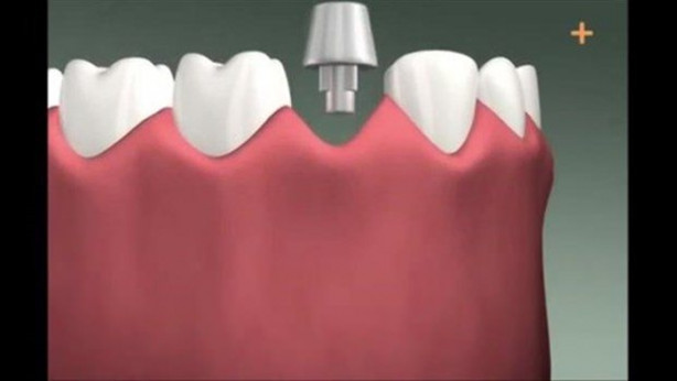Foto - Diş implantı nasıl yapılıyor?