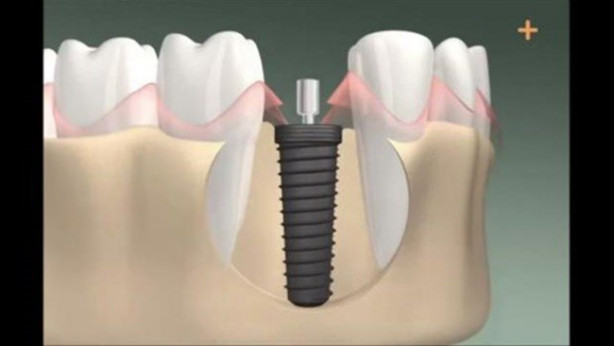 Foto - Diş implantı nasıl yapılıyor? İşte cevabı...
