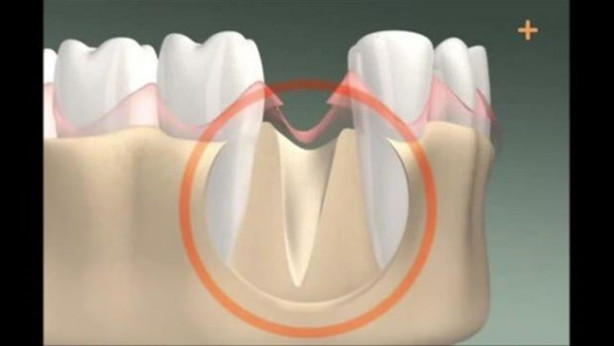 Foto - Diş implantı nasıl yapılıyor? İşte cevabı...