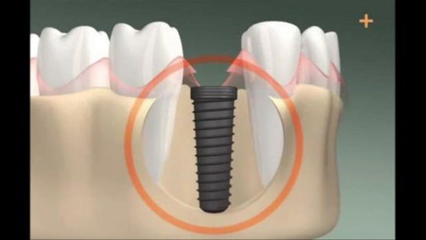 Foto - Diş implantı nasıl yapılıyor? İşte cevabı...