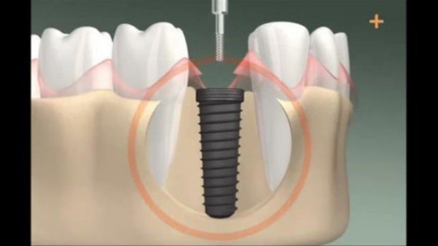 Foto - Diş implantı nasıl yapılıyor? İşte cevabı...