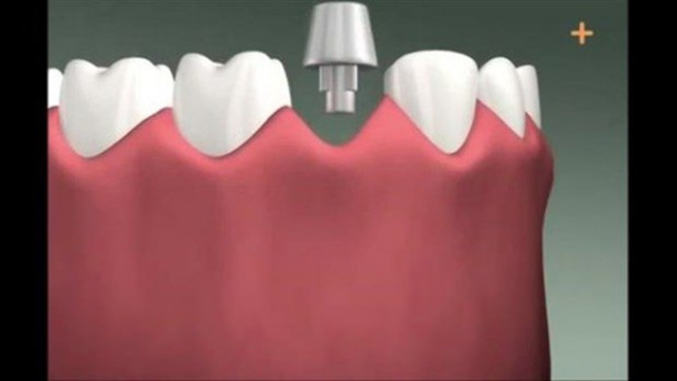 Foto - Diş implantı nasıl yapılıyor? İşte cevabı...