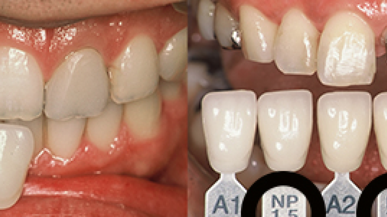 Foto - Diş rengi sağlık hakkında ipuçları veriyor! O zıkkımdan uzak durmalısınız! Ayrıntılara dikkat