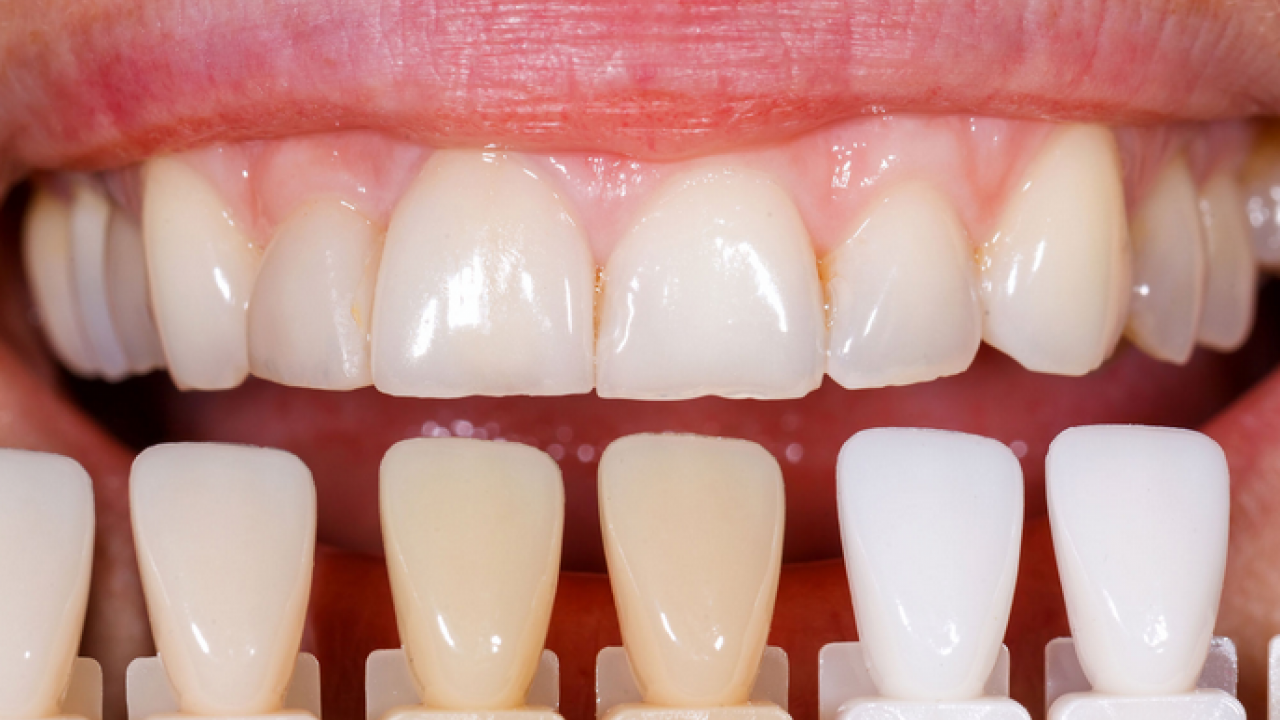 Foto - Diş rengi sağlık hakkında ipuçları veriyor! O zıkkımdan uzak durmalısınız! Ayrıntılara dikkat
