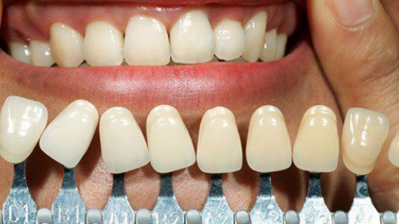 Foto - Diş rengi sağlık hakkında ipuçları veriyor! O zıkkımdan uzak durmalısınız! Ayrıntılara dikkat