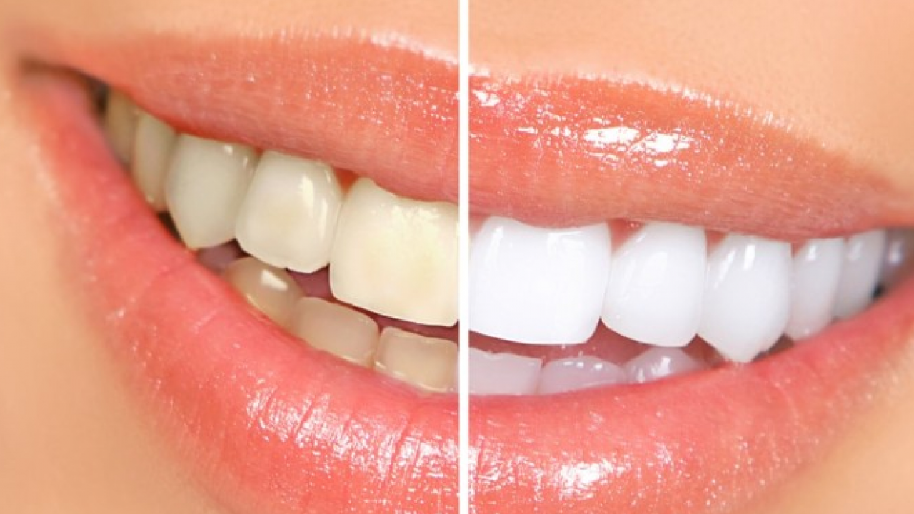 Foto - Diş rengi sağlık hakkında ipuçları veriyor! O zıkkımdan uzak durmalısınız! Ayrıntılara dikkat