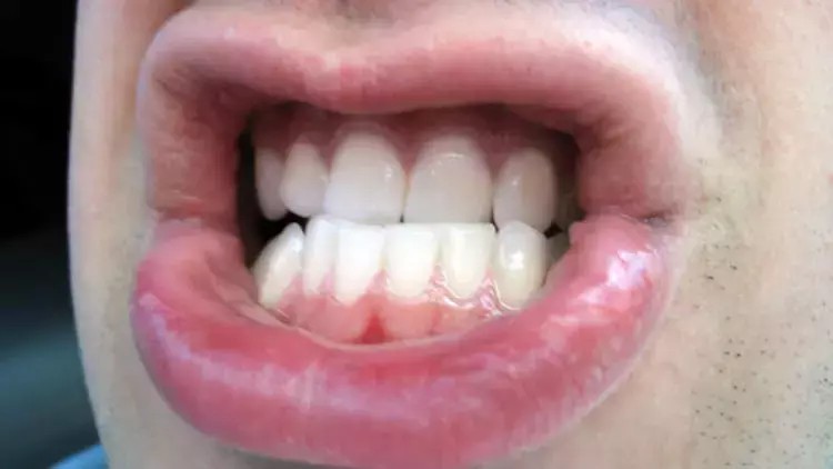 Foto - Diş sıkmanın yol açtığı sorunlara dikkat!