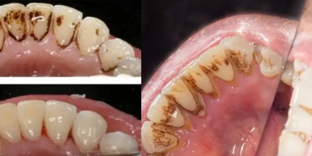 Diş tartarı bitkisel çözüm: Diş sararması nasıl geçer? Dikkat! Hiç bilinmeyen özelliği, detay