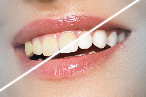 Foto - Dişleri doğal yollarla beyazlatmak için teknikler