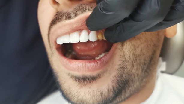 Foto - Dişleri doğal yollarla beyazlatmak için teknikler