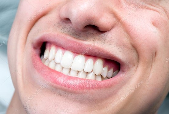 Dişleri mahveden alışkanlık: Bunu sakın yapmayın!