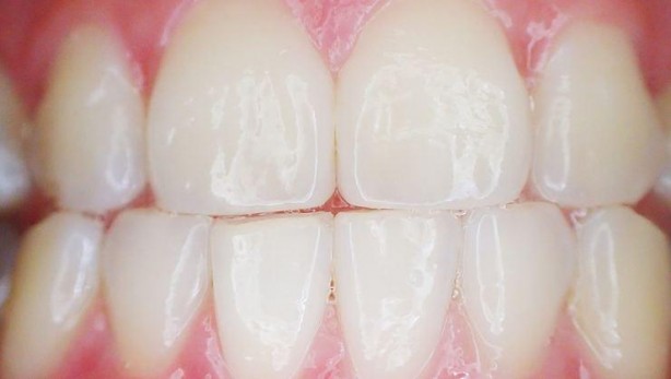 Foto - Dişleri yok eden yiyecekler