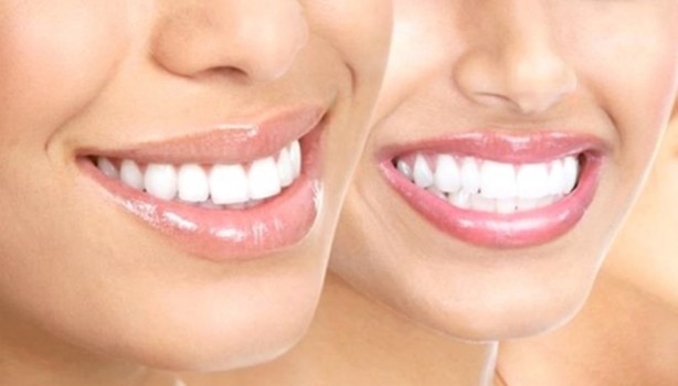 Foto - Dişlerinizi alüminyum folyo ile kaplarsanız ne olur?