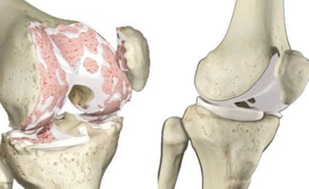 Foto - Diz ağrısına, kireçlenmeye iyi gelen bamya tohumu kürü: Şifası 'yok artık' dedirtecek...