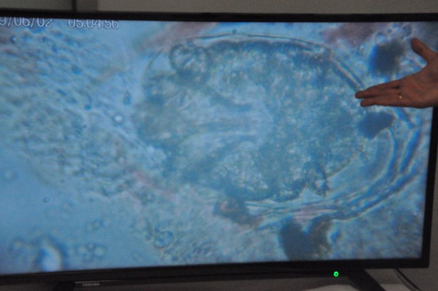 Foto - Doç. Dr. Yürekli: Pandemi uyuz vakalarını patlattı!