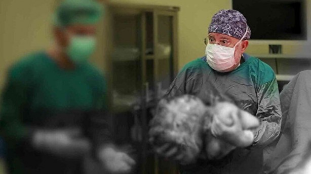 Foto - Doktor bile şok oldu! Karnından 16,9 kiloluk dev kitle çıktı