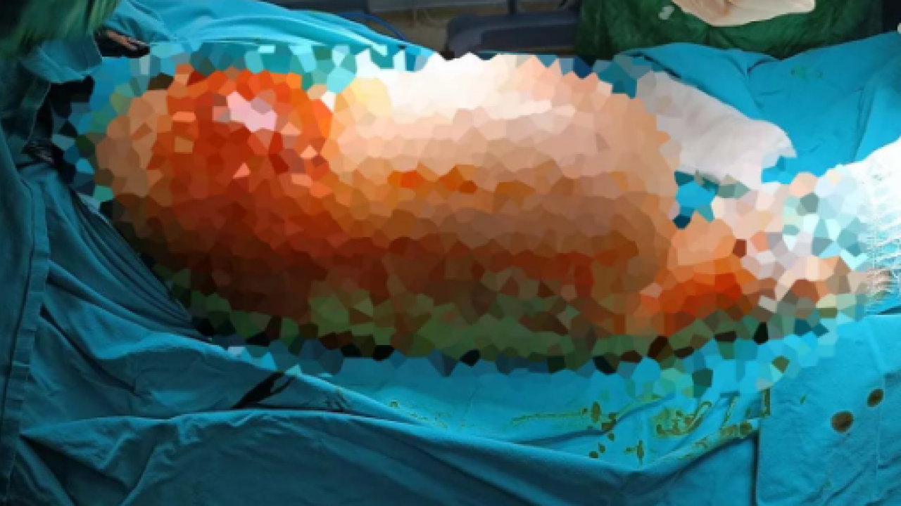 Doktorlar bile inanamadı! Bacağından çıkan şey tam 5 kilo 668 gram
