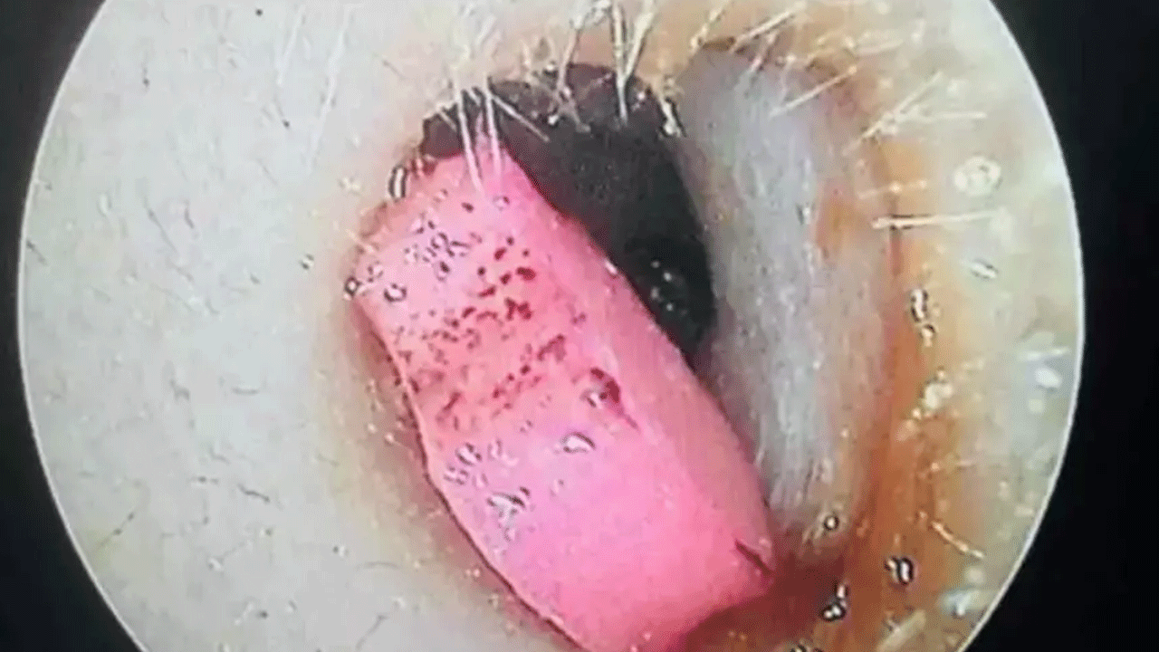 Foto - Doktorlar bile şaşkına döndü! 5 yaşındaki çocuğun kulağından bakı ne çıktı!