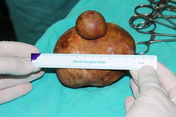 Foto - Doktorlar bile şaşkına döndü! Mesanesinden 1 kilo taş çıktı
