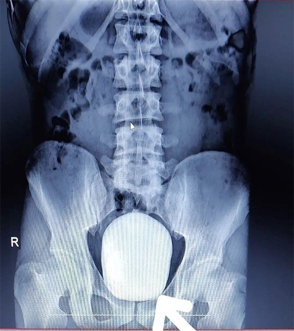 Doktorlar bile şaşkına döndü! Mesanesinden 1 kilo taş çıktı