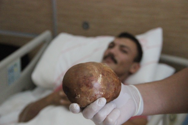 Foto - Doktorlar bile şaşkına döndü! Mesanesinden 1 kilo taş çıktı