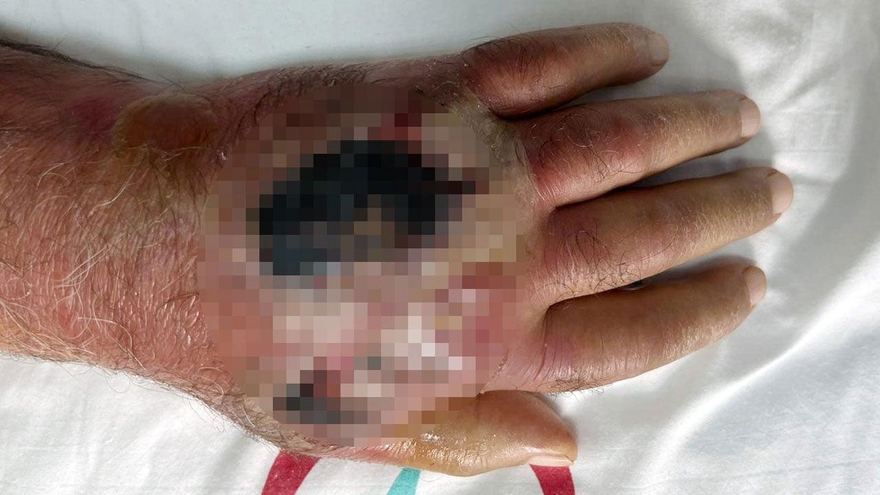 Doktorlar bile şaştı! Hırsız elini ısırdı nadir vaka gelişti