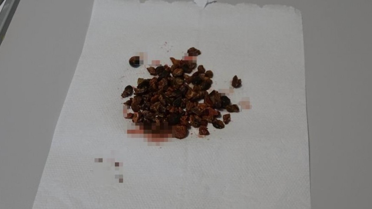 Foto - Doktorlar bile şaştı kaldı! Bakın böbreğinden kaç tane taş çıktı