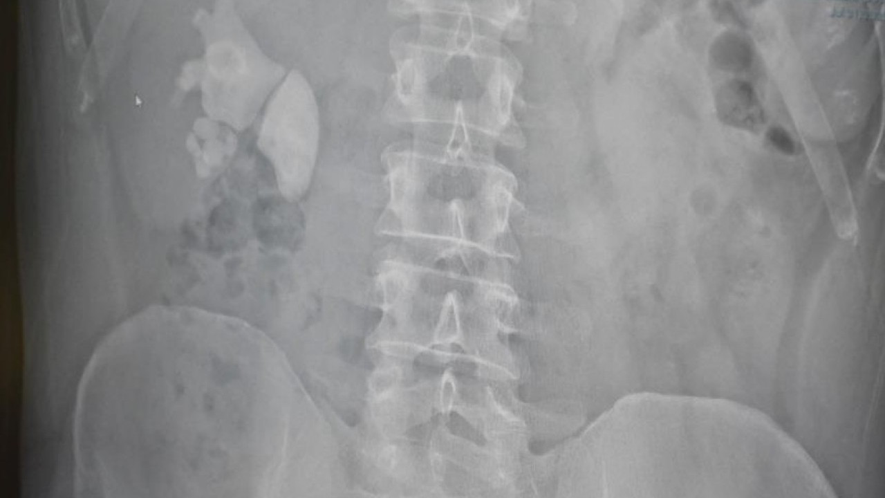 Foto - Doktorlar bile şaştı kaldı! Bakın böbreğinden kaç tane taş çıktı