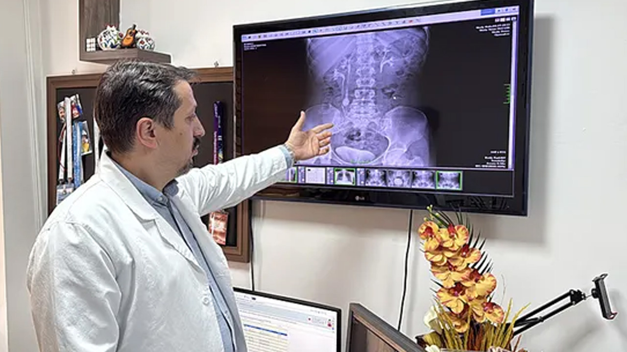 Doktorlar bile şoke oldu: Böbrek taşı yapıyormuş! Adeta zehir saçıyor