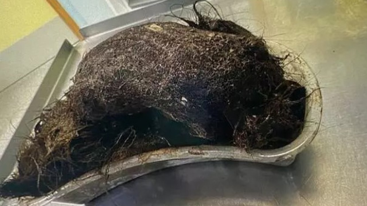 Foto - Doktorlar dehşete düştü: 14 yaşındaki kızın karnından bakın ne çıktı!