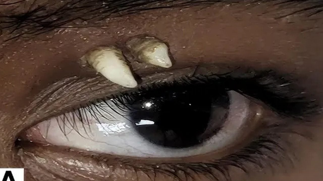 Doktorlar şoke oldu, tıp dünyası bu vakayı konuşuyor: 16 yaşındaki çocuğun gözünde diş çıktı