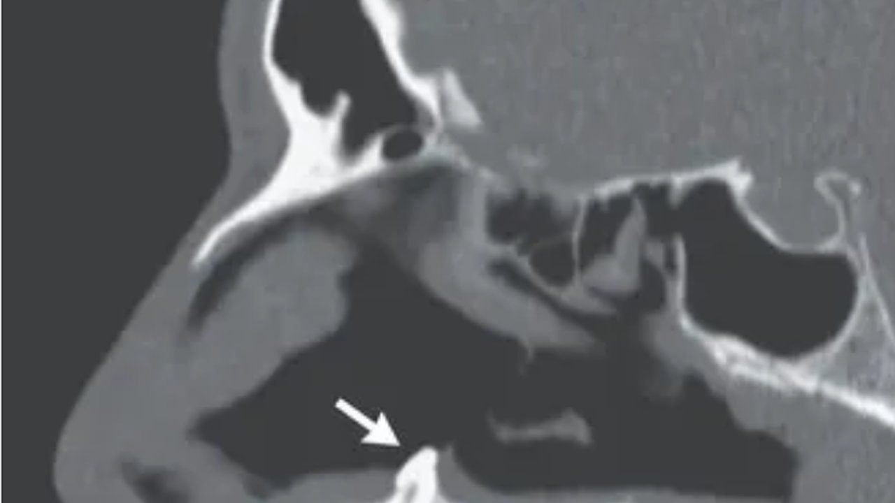 Foto - Doktorlar şoke oldu, tıp dünyası bu vakayı konuşuyor: 16 yaşındaki çocuğun gözünde diş çıktı