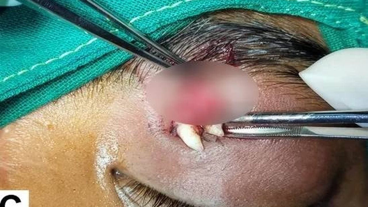 Foto - Doktorlar şoke oldu, tıp dünyası bu vakayı konuşuyor: 16 yaşındaki çocuğun gözünde diş çıktı