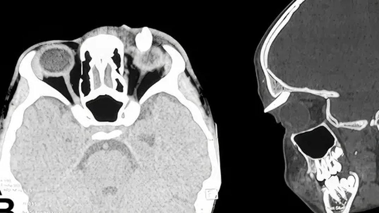 Foto - Doktorlar şoke oldu, tıp dünyası bu vakayı konuşuyor: 16 yaşındaki çocuğun gözünde diş çıktı