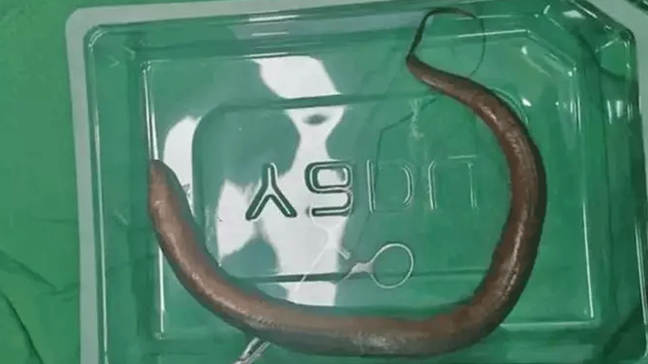 Foto - Doktorları şaşkına çeviren vaka: Karnından çıkana inanamadılar!!!