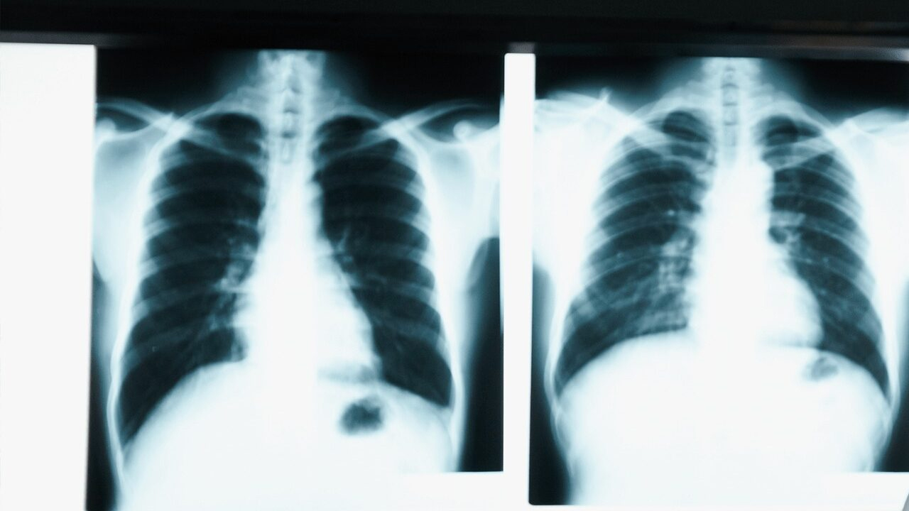 Foto - Dünya kanser ölümlerine ilişkin rapor yayımladı: Büyük artışla karşı karşıya uyarısı! Beklenmedik şeklinde artıyor