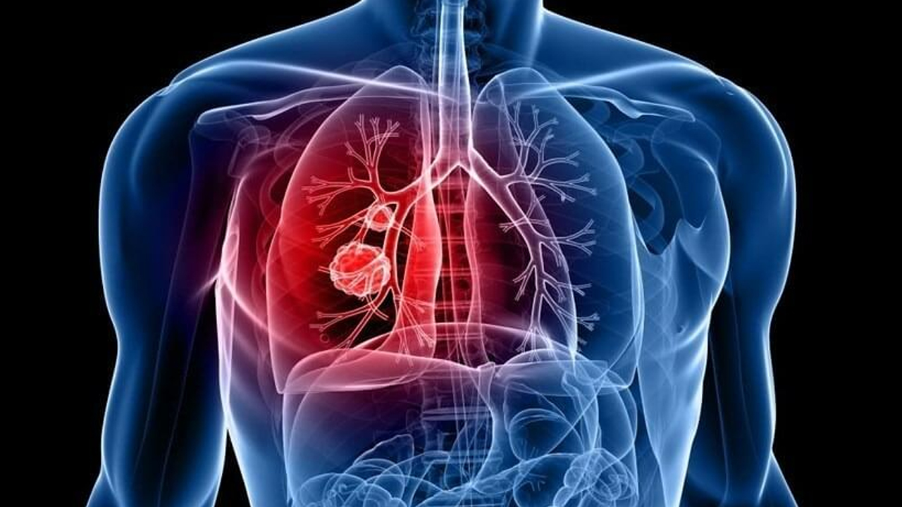 Dünya kanser ölümlerine ilişkin rapor yayımladı: Büyük artışla karşı karşıya uyarısı! Beklenmedik şeklinde artıyor