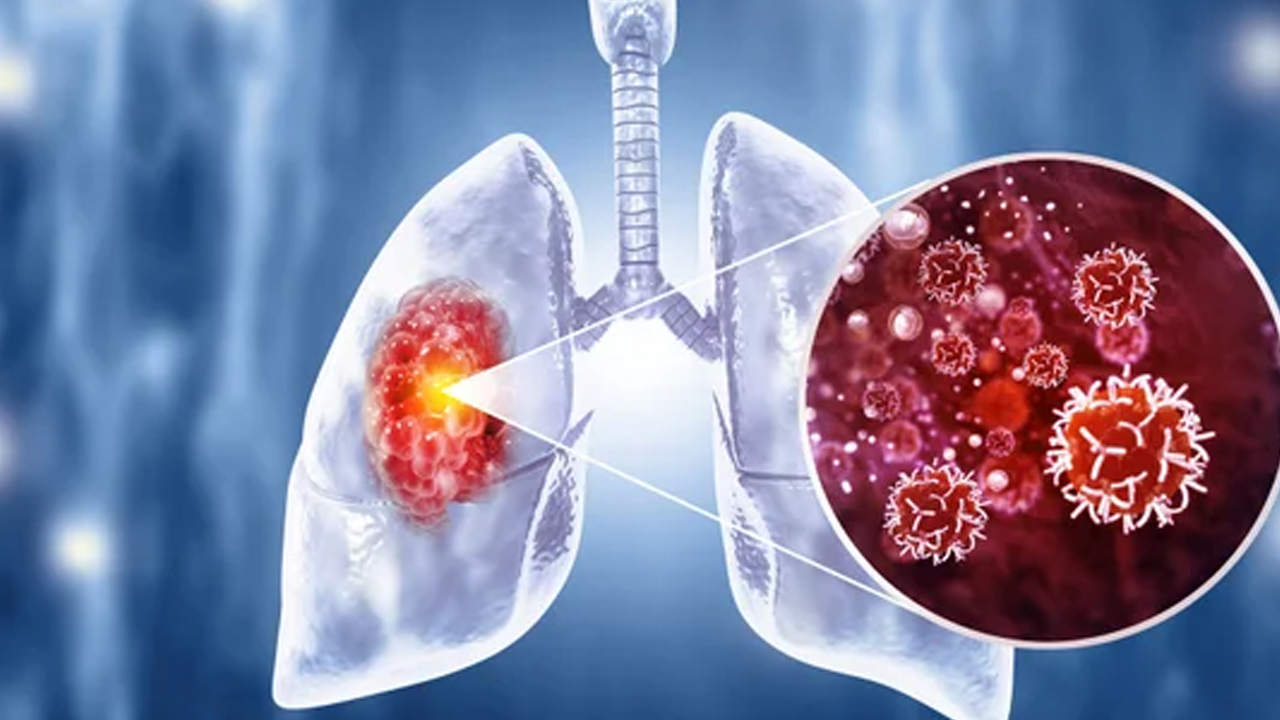 Foto - Dünya kanser ölümlerine ilişkin rapor yayımladı: Büyük artışla karşı karşıya uyarısı! Beklenmedik şeklinde artıyor