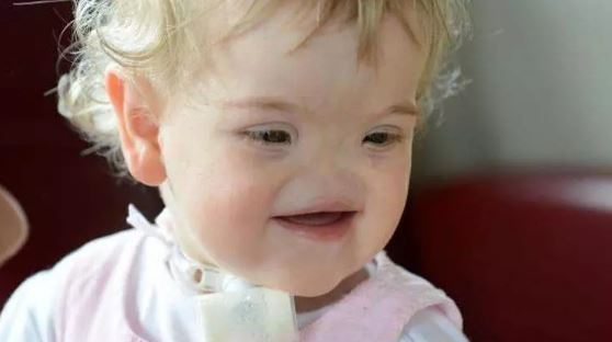 Foto - Dünya onu konuşuyordu! Burunsuz doğan bebek büyüdü: İşte son hali...