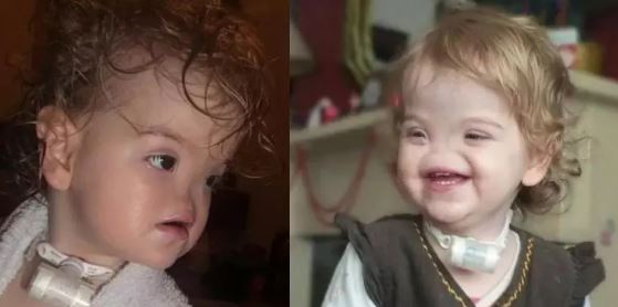 Foto - Dünya onu konuşuyordu! Burunsuz doğan bebek büyüdü: İşte son hali...