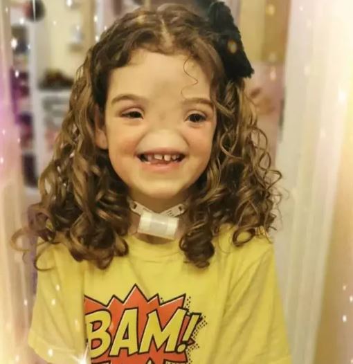 Foto - Dünya onu konuşuyordu! Burunsuz doğan bebek büyüdü: İşte son hali...