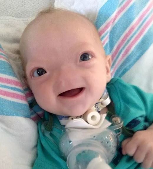 Foto - Dünya onu konuşuyordu! Burunsuz doğan bebek büyüdü: İşte son hali...