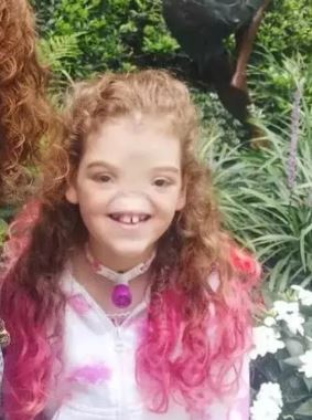 Foto - Dünya onu konuşuyordu! Burunsuz doğan bebek büyüdü: İşte son hali...