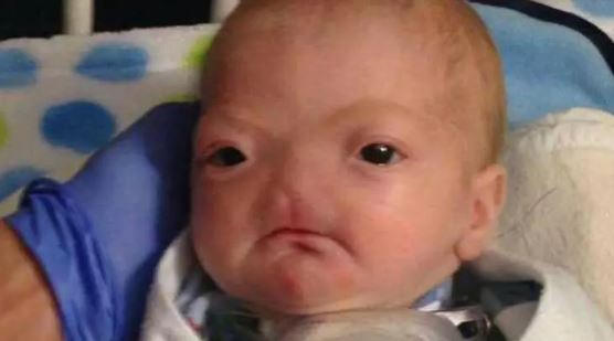 Dünya onu konuşuyordu! Burunsuz doğan bebek büyüdü: İşte son hali...