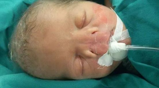 Foto - Dünya onu konuşuyordu! Burunsuz doğan bebek büyüdü: İşte son hali...